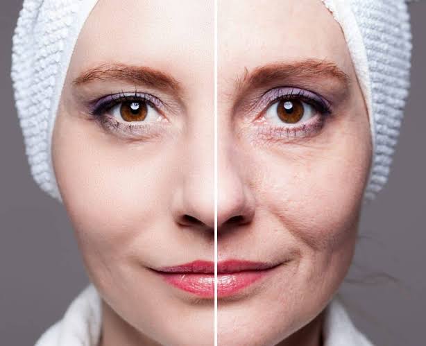 Dermal Fillers