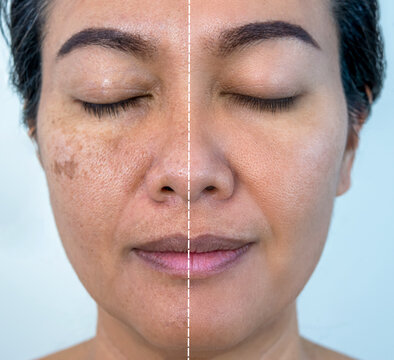 Pigmentation Treatment