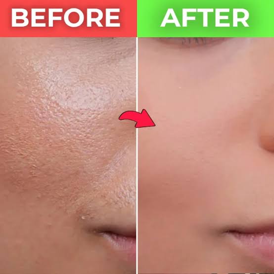 Open Pore Treatment