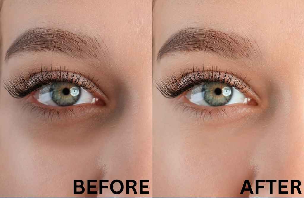 Double Chin Reduction