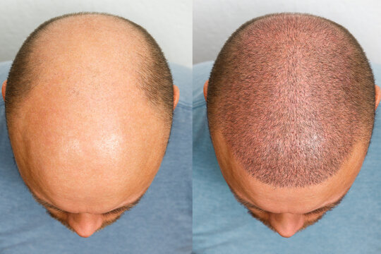 Hair Restoration